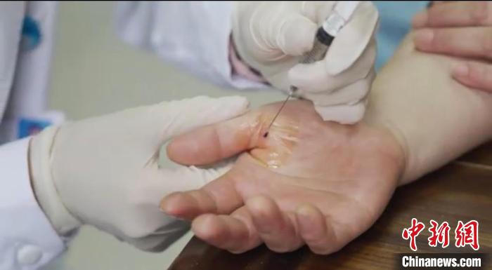 嘉善群眾體驗小針刀?！〖紊平y(tǒng)戰(zhàn) 供圖