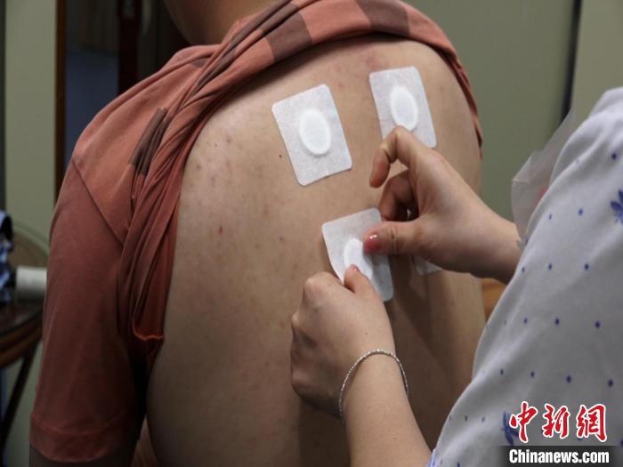 圖為醫(yī)生正在為民眾貼“三伏貼”?！√莆登?攝